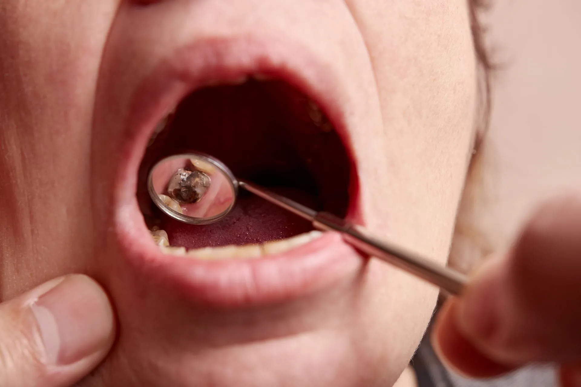 Oral Cancer Screening — what to know