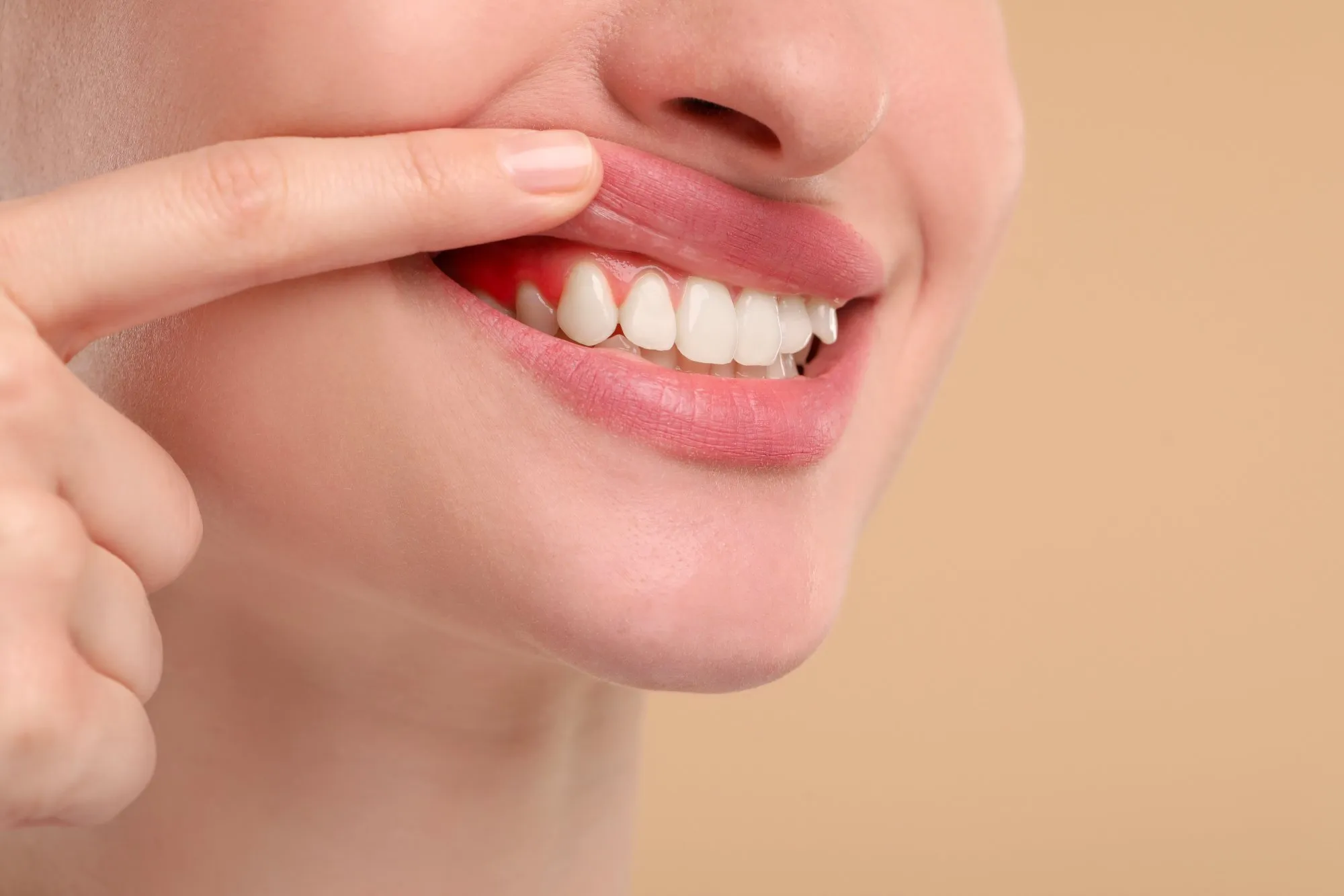 Teeth Whitening — what to know
